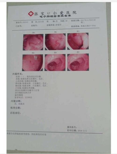 出血性直肠炎调理案例