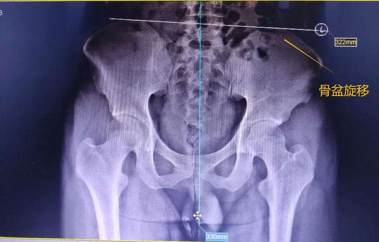 有一种腰腿疼痛叫骨盆旋移症!