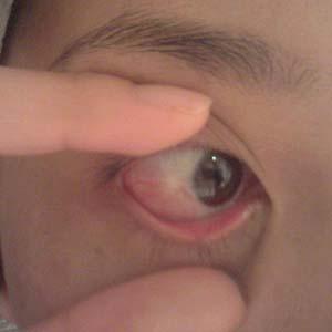 白内障早期图片