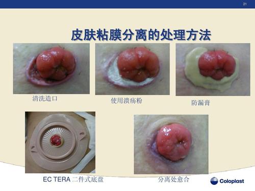 ppt 第21页 (共30页,当前第21页) 你可能喜欢 造口并发症 造瘘口护理
