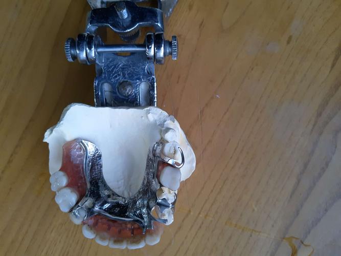 口腔科 患者男,72岁,因上颌部分牙列缺失8年前在我院行可摘局部义齿