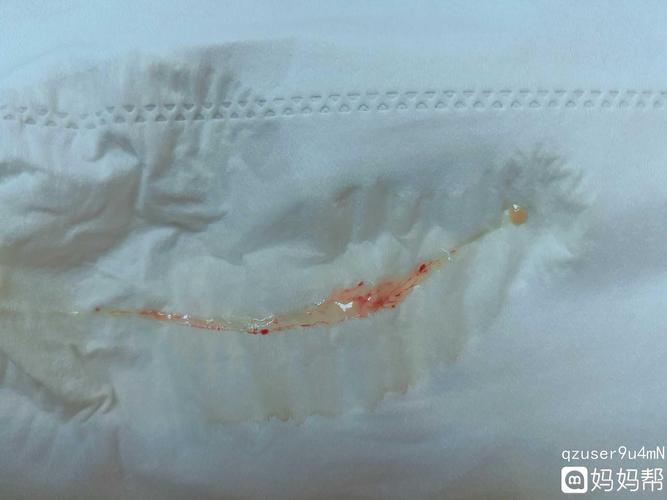 我小便有拉丝带点血,请问大家这是排卵期白带拉丝吗