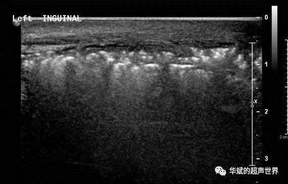 典型病例61福涅尔坏疽与气肿性睾丸附睾炎的鉴别坏死性筋膜炎气肿性