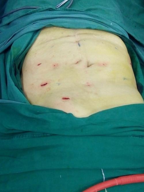 带你认识切口疝手术