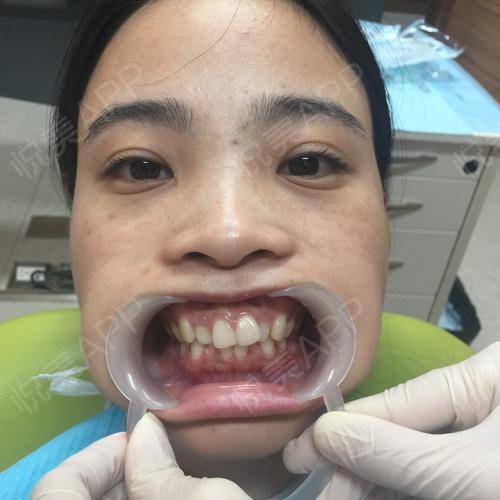 矫正手术当天_牙齿矫正手术当天_牙齿美容手术当天_为爱控分享图片2