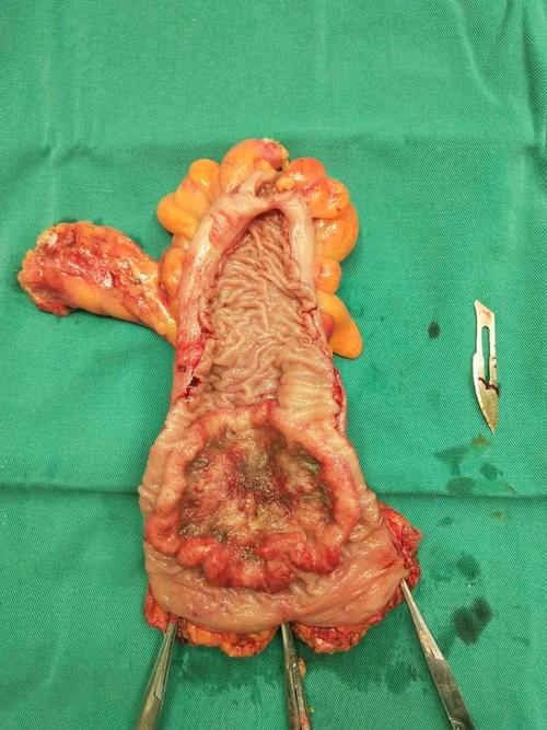 腹腔镜直肠乙状结肠交界癌 胃贲门肿瘤切除术