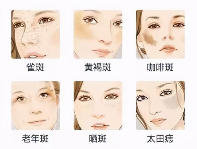 最全色斑详解带你认识雀斑黄褐斑日晒斑贝颜贝颜美容