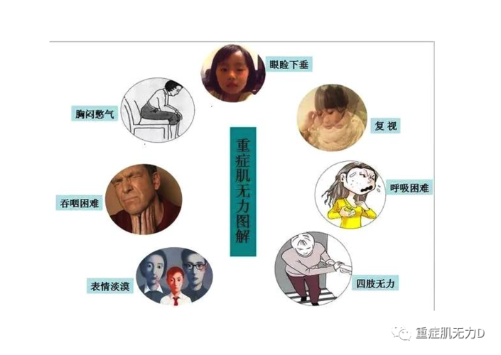 重症肌无力怎么办?