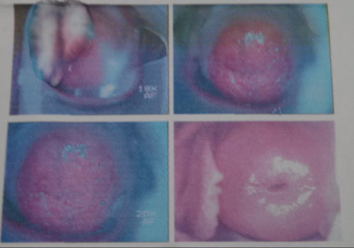 宫颈糜烂中度严重吗