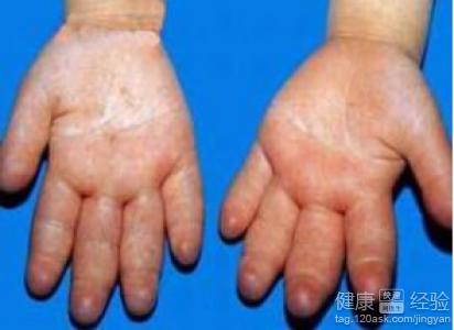 肝源性水肿怎么引起的