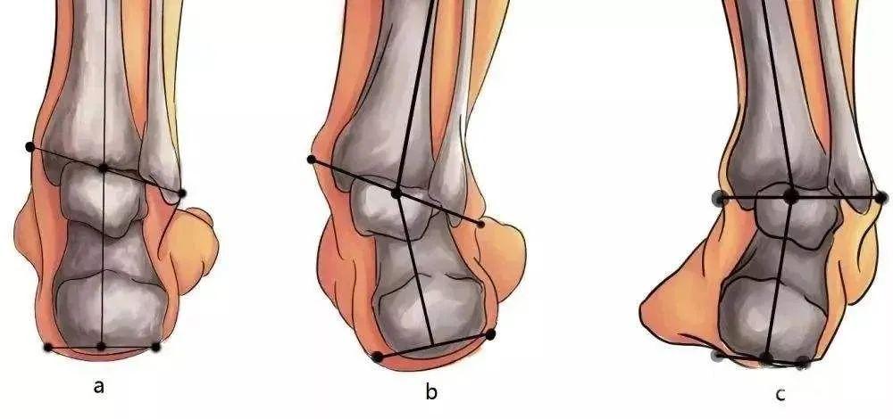 踝关节内侧疼痛需警惕可能是胫后肌功能不全