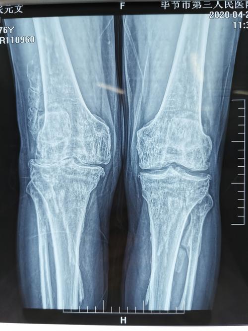 ct提示双膝关节退变,双侧胫腓骨局部骨皮质增厚并条索状突起,骨刺增粗