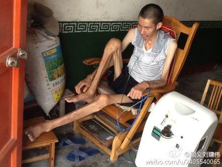 顺义刘建伟骨瘦如柴的尘肺病人尘肺病是由于生产场所粉尘浓度超标企业