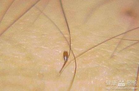 怎么样治疗阴虱病