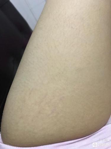 宝妈们长妊娠纹了吗?