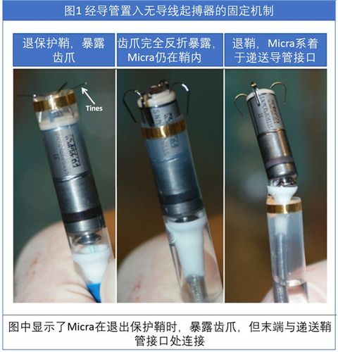 无导线起搏器的应用和进展