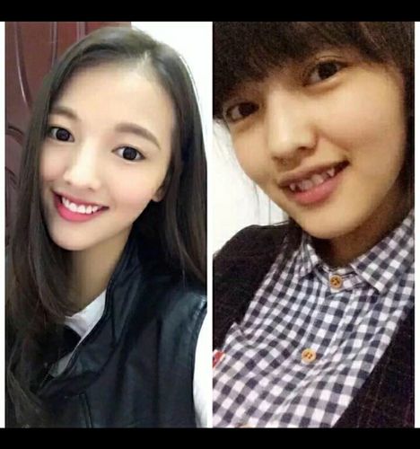 拔虎牙矫正,3个月排齐~_牙套_正畸_牙医_牙齿美白_脸型_美妆_医美整形