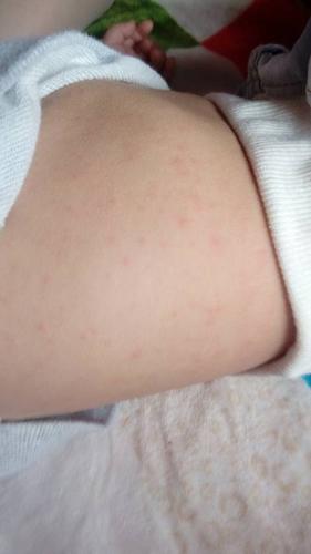 宝宝全身出疹子了,怎么办?:只看楼主