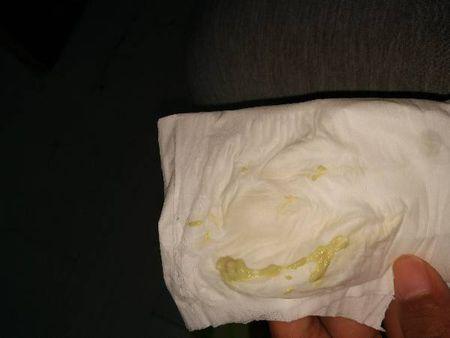 白带这个样子!正常吗!不知道是什么原因!好担心