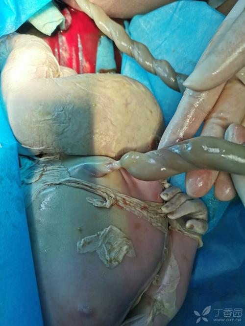 足月死胎,生下来发现了这个 [病例帖]