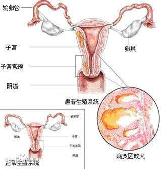 子宫腺肌症的治疗