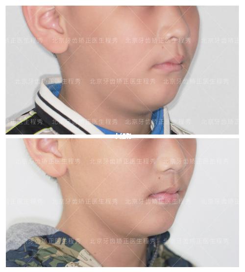 9岁小朋友下颌后缩,戴功能性矫治器3个半月_牙齿矫正