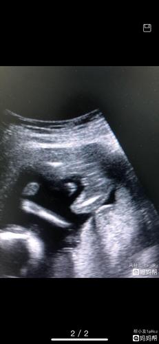 15周b超女孩,看到三条线,确认是女宝