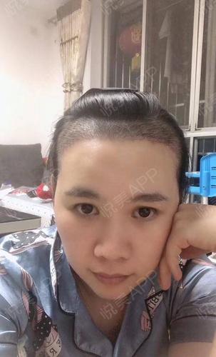 一直不觉得自己发际线很高就觉得少了两个猫耳朵植完后才发觉原来自己