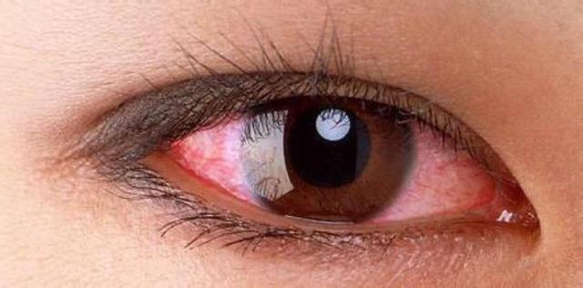 为什么眼睛经常会有红血丝