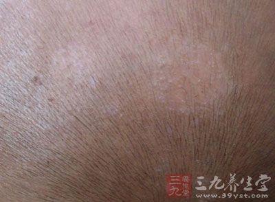 头癣的症状 三种常见症状儿童最易感染