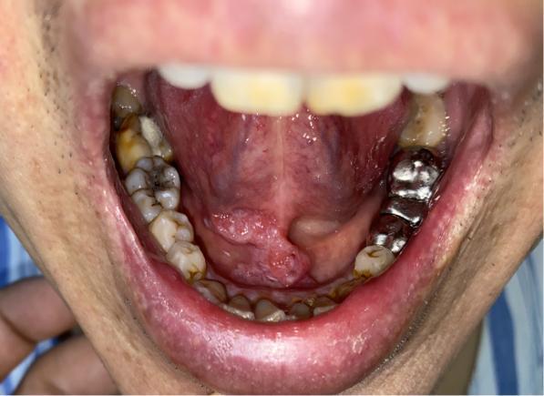 迎春节送健康丨哈医大一院口腔专家提示别小看口腔溃烂要小心口腔癌