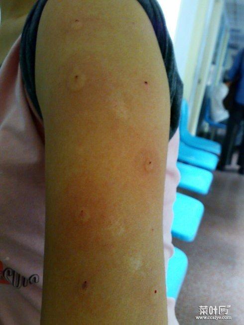 螨虫咬红肿硬图片 脸上痘痘红肿很硬很痛