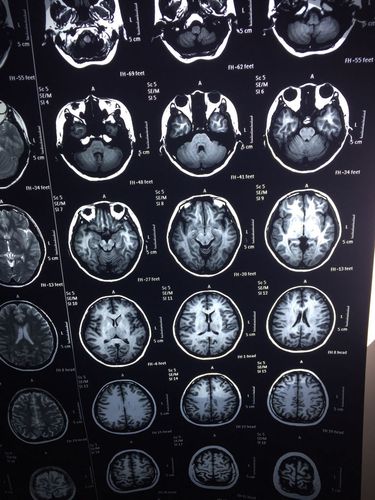 磁共振显示脱髓鞘病变,考虑先天发育不良,需要治疗吗?