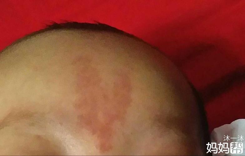  我家的额头上是血管瘤吗,会消退