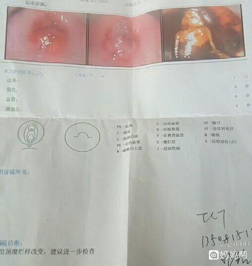 我想知道这是宫颈糜烂几度