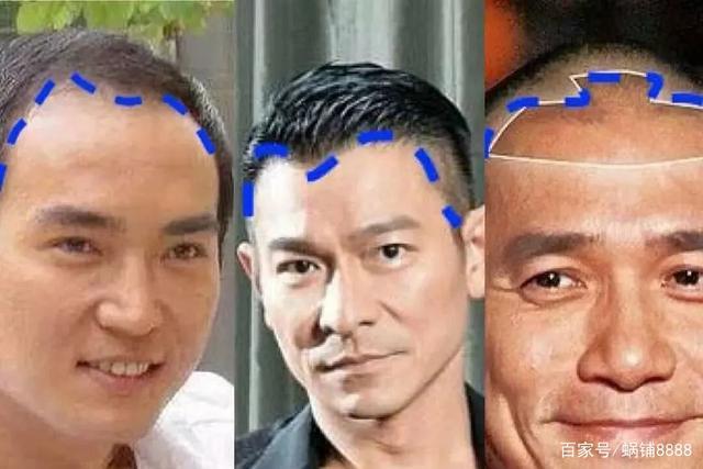 为什么现在的年轻人容易脱发呢?
