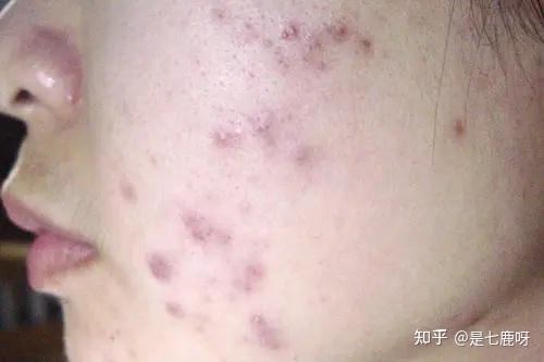 如图我这个是挤完痘痘留下来的 这是痘疤吗 要怎么去除?