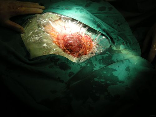 腹部肿块病例讨论一例