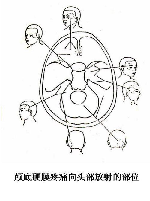 头痛的解剖学分析 4