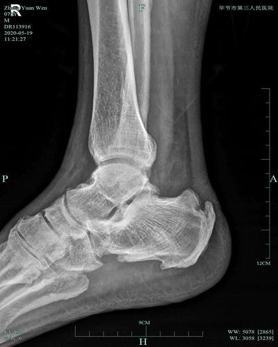 弥漫性特发性骨肥厚症并双膝关节骨性关节炎一例