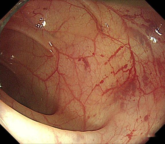 医学课堂|一例结直肠血管扩张症患者的诊断与分析