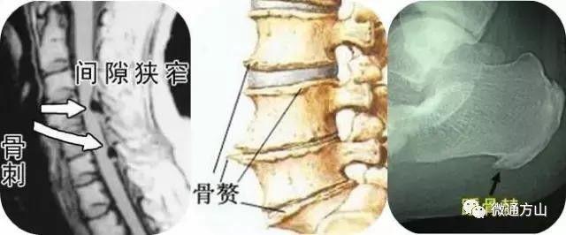 图片依次为:颈椎骨刺,腰椎骨刺,跟骨骨刺