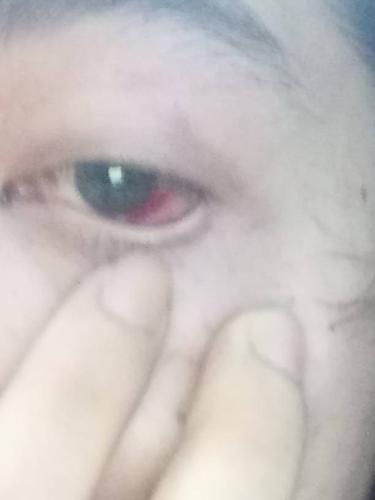 眼睛里面有血红色,昨晚上碰到的,还会不会好的,怎么办