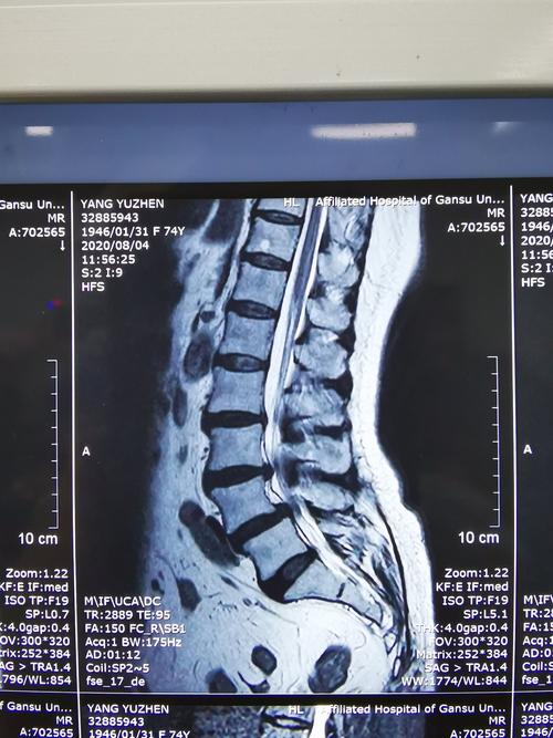一台l4滑脱并椎间盘突出椎管狭窄的患者,今日行内镜下减压融合并内