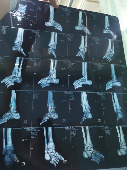 骨折ct胫腓两处骨折 脚踝旋转