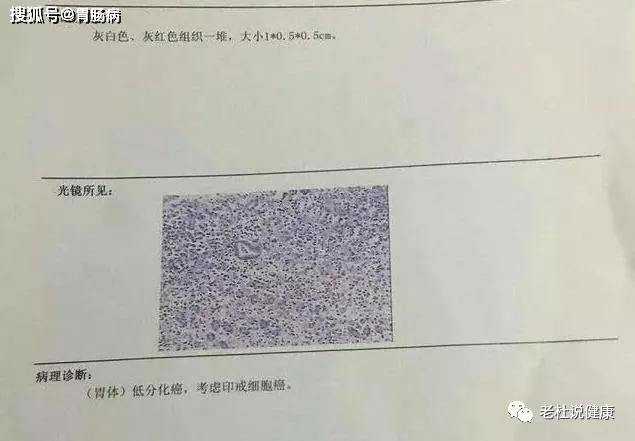 于是在6月26日重新做了胃镜,并取了活检.