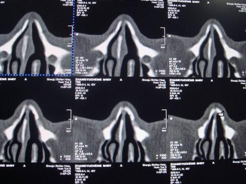 ct21424鼻骨骨折