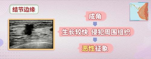 恶性的乳腺结节有这3种表现,一旦发现,千万别大意!