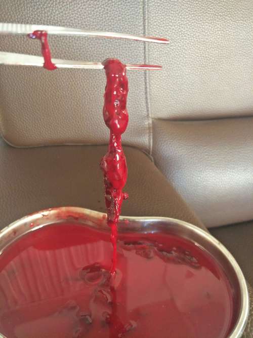 取出来的血栓子