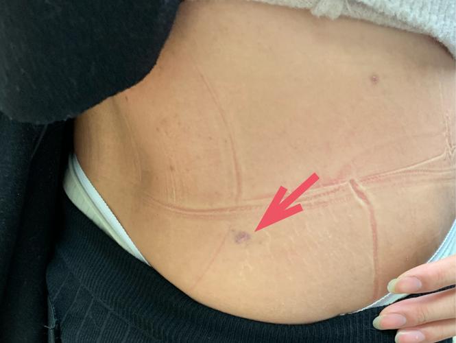 上虞人民医院开启腰椎间盘突出症的微创时代 7.